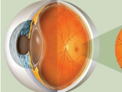 dmri-degeneração-macular-relacionada-a-idade[1]